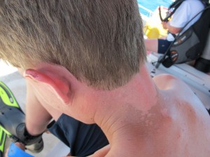 When you don't wear your sunscreen, part I.  Note:  ears.