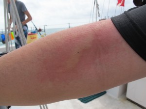 The welt is from fire coral.