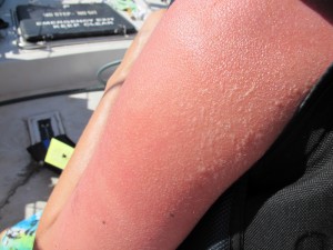 This is what happens when you don't wear your sunscreen!  Ouch!